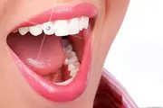 چرایی کاشت نگین روی دندان