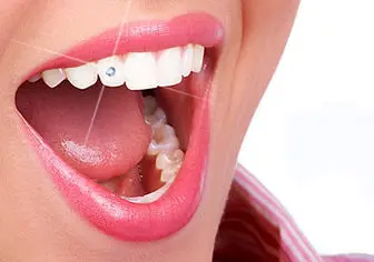 در خصوص کاشت «نگین دندان» بیشتر بدانید