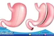 خطرات و عوارض عمل اسلیو معده چیست و آیا ارزش ریسک کردن دارد؟
