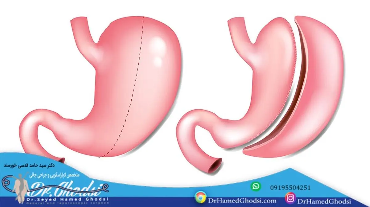 خطرات و عوارض عمل اسلیو معده چیست و آیا ارزش ریسک کردن دارد؟
