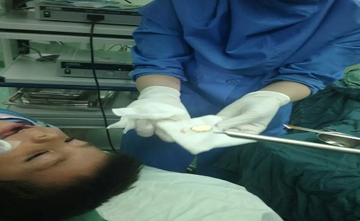 
خروج سکه از مری کودک 2 ساله
