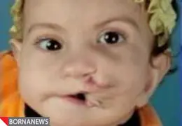 جراحی موفقیت آمیز کودکی با دو دهان + عکس