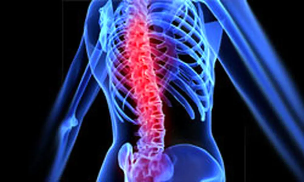 محققان دیسک مصنوعی ستون فقرات ساختند