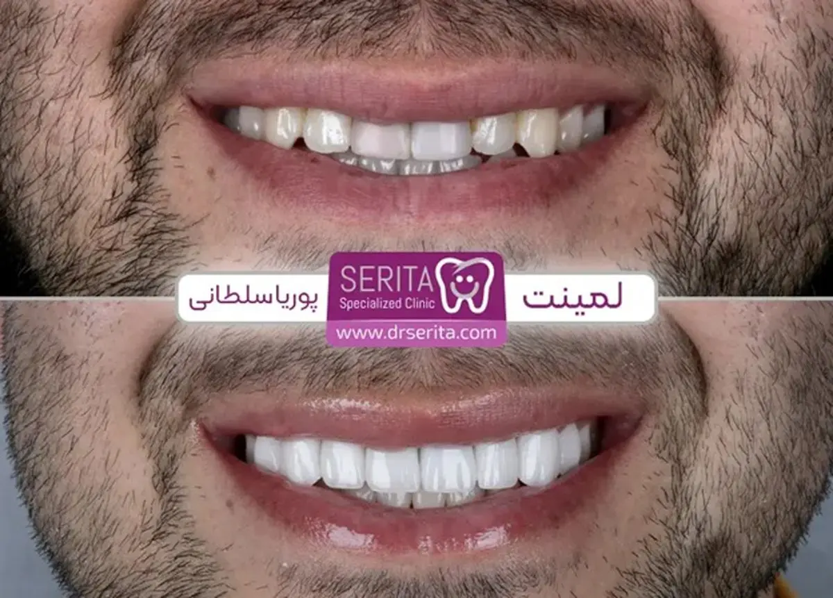 تفاوت کامپوزیت و لمینت با یکدیگر؟