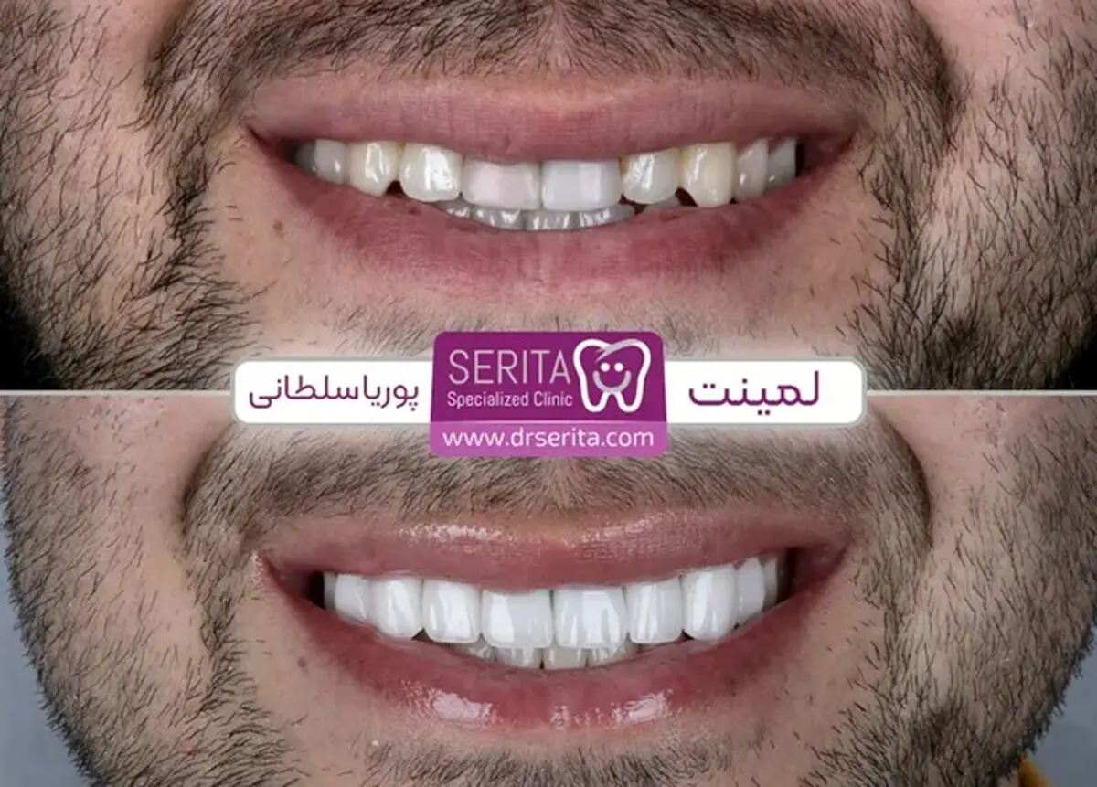تفاوت کامپوزیت و لمینت با یکدیگر؟