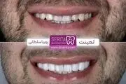 تفاوت کامپوزیت و لمینت با یکدیگر؟