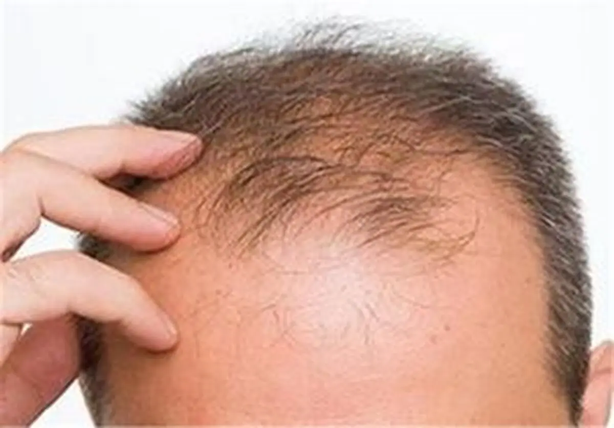 
باکتری‌ها چه نقشی در ریزش موی سر دارند؟
