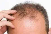 
باکتری‌ها چه نقشی در ریزش موی سر دارند؟
