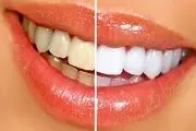 عوارض سفیدکردن دندان ها!