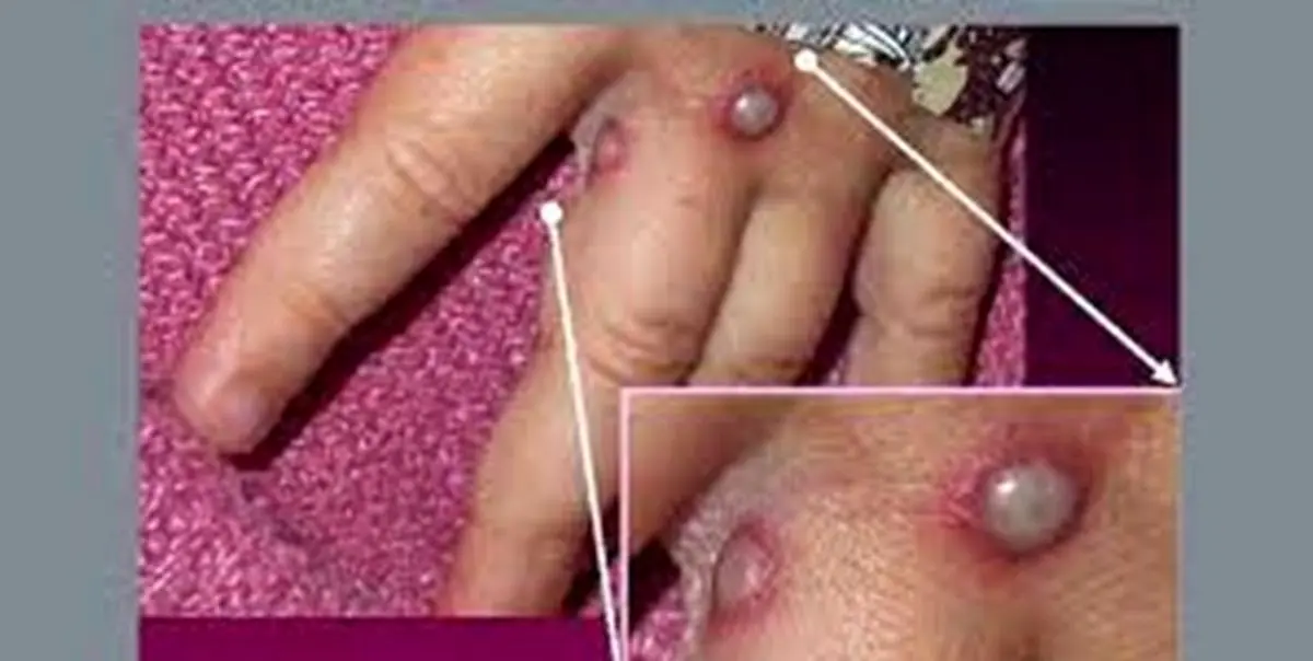 نقش آمریکا در شیوع «آبله میمون» را بررسی کنید