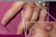 نقش آمریکا در شیوع «آبله میمون» را بررسی کنید