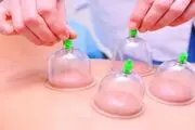 از این ضررها و عوارض حجامت آگاه باشید!