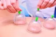 از این ضررها و عوارض حجامت آگاه باشید!