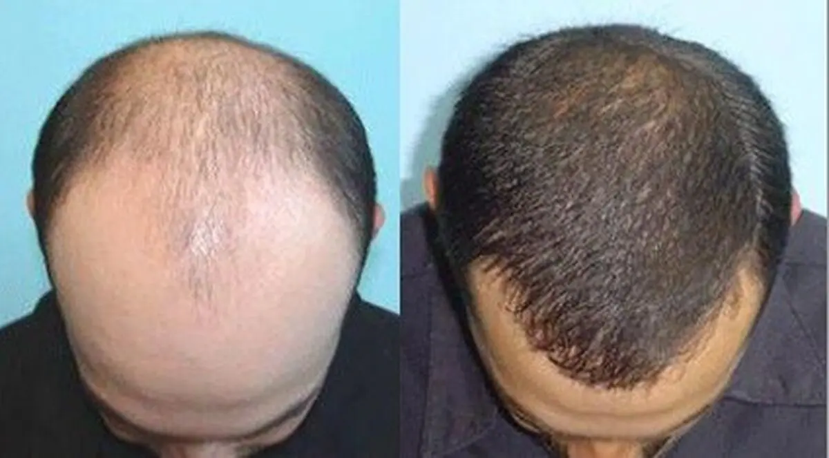 چند راهکار ساده اما بسیار مؤثر برای پرپشت‌شدن موها
