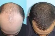 چند راهکار ساده اما بسیار مؤثر برای پرپشت‌شدن موها
