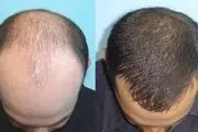 چند راهکار ساده اما بسیار مؤثر برای پرپشت‌شدن موها
