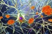 نمونه مایع نخاعی بیماری آلزایمر را پیش بینی می‌کند

