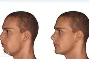 از عمل ژنیوپلاستی  چه می‌دانید؟