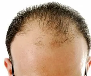 چرا ریزش ارثی مو در تابستان بیشتر می‌شود؟