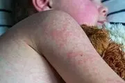 صدای پای این بیماری خطرناک به گوش می‌رسد
