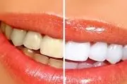 عوارض استفاده از سفید کننده های دندان