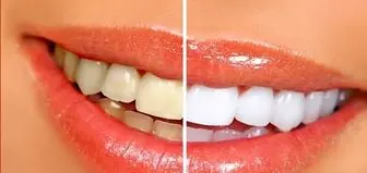 «دندانهایی سفید و درخشان» داشته باشید