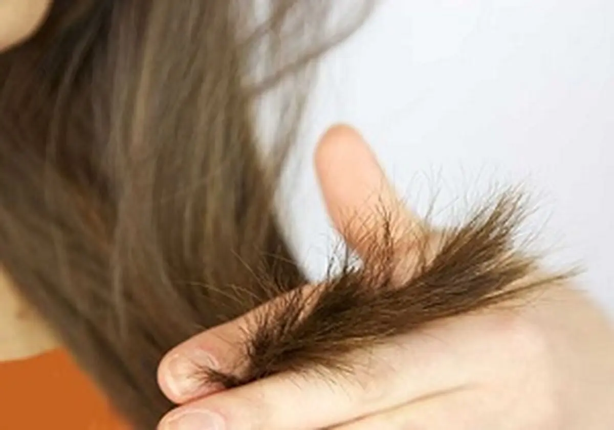۷ روش برای خلاصی از موخوره+ اینفوگرافیک
