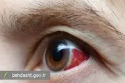 از سکته چشم چقدر می‌دانید؟!