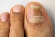 ۶ راهکار خانگی برای درمان قارچ ناخن پا
