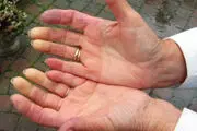 از بیماری اسکلرودر چه می دانید؟