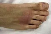 علائم آرتروز پا را بشناسید