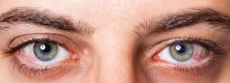 توصیه های مهم برای حفظ بهداشت چشم‌ها در دوران کرونا/ اینفوگرافی