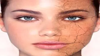 دلایل تشدید خشکی پوست صورت+ درمان
