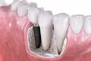 آسان ترین راه توقف دندان درد