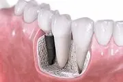 عفونت لثه را جدی بگیرید
