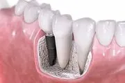 عفونت لثه را جدی بگیرید