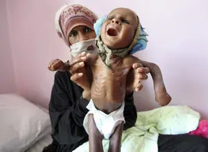 افزایش شمار قربانیان وبا در یمن به بیش از 2000 نفر