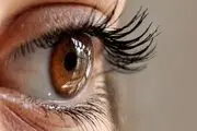تشخیص یک بیماری نادر چشم که می‌تواند منجر به نابینایی شود
