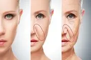 قیمت تزریق ژل خط خنده در زمستان 1402