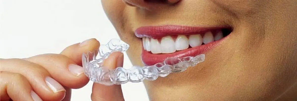 لبخندی فریبنده با ارتودنسی نامرئی