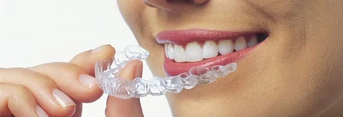 لبخندی فریبنده با ارتودنسی نامرئی