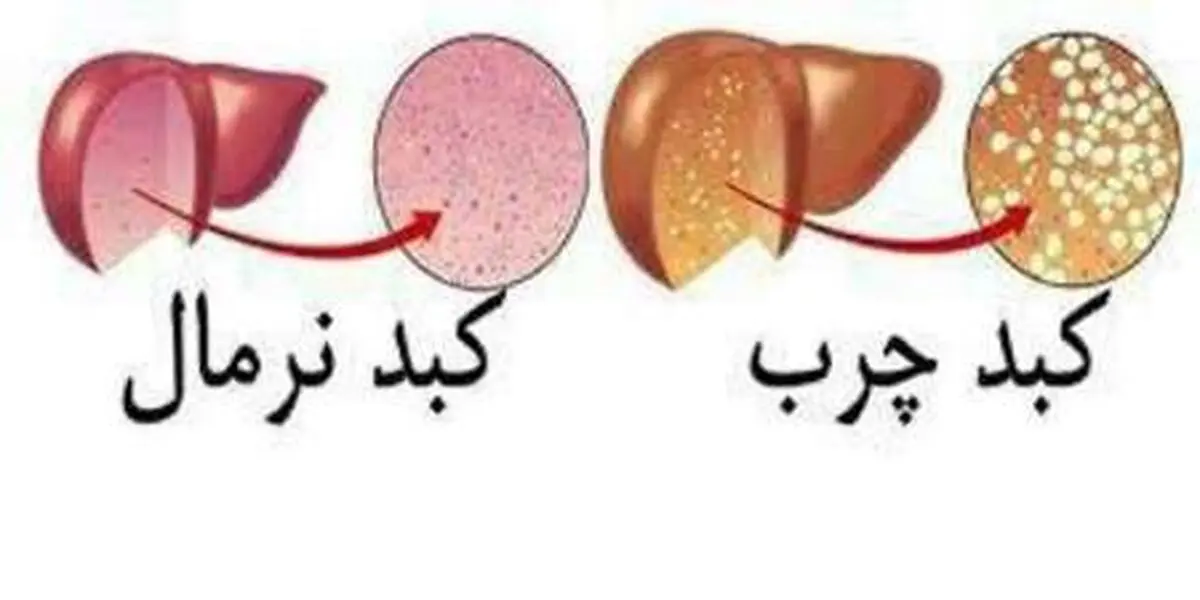 مهمترین دلیل چرب شدن کبد مشخص شد