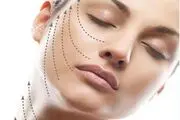 گام به گام با لیفت با نخ جدید ترین روش زیبایی صورت