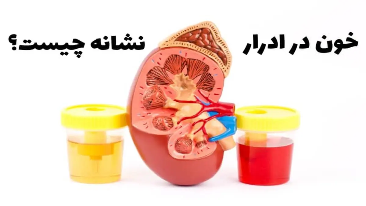 ادرار خونی نشانه چیست؟