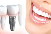 انتخاب یک متخصص ایمپلنت خوب با دندانپزشکان ایران