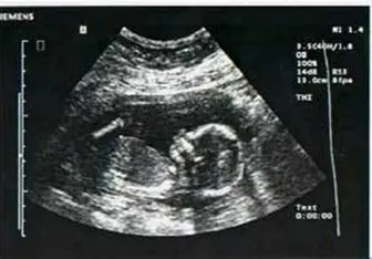 سونوگرافی‌های یادگاری از جنین ممنوع