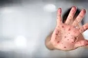 سرایت هراس از شیوع آبله میمون به آمریکای لاتین