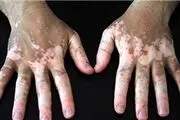  راهکارهای درمانی بیماران مبتلا به پیسی