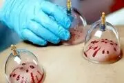 بیمه فصد و حجامت، موافقان و مخالفان چه می‌گویند