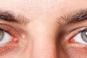 خشکی چشم؛ دلایل، نشانه‌ها و درمان